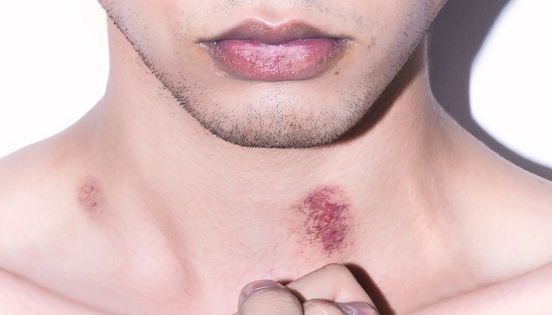 Hé lộ sự thật: Hickey là gì mà tại sao con trai lại thích?