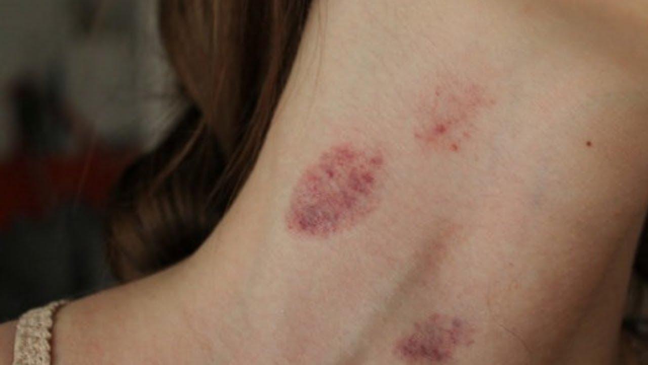 Nụ hôn hickey có thể khiến đối phương cảm thấy khó chịu và đau đớn